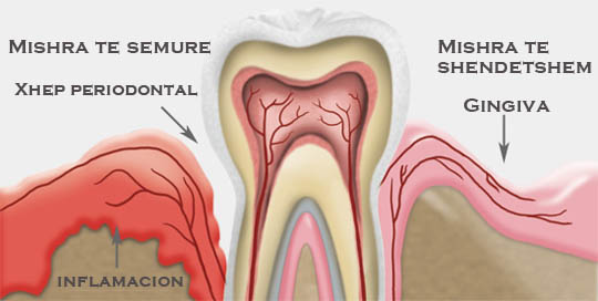 semundja periodontale